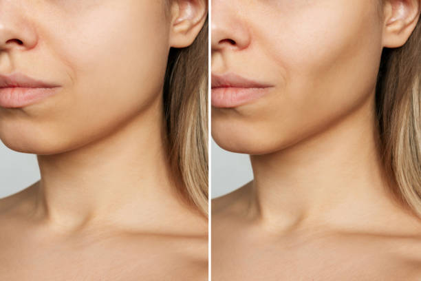 How to Get Rid of Chubby Cheeks – Face Slimming Tips & Buccal Fat Facts